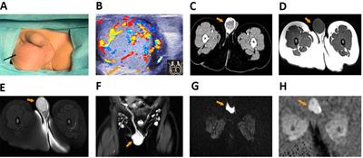Ultrasonic misdiagnosis of giant pediatric testicular yolk sac tumor: A case report and literature review